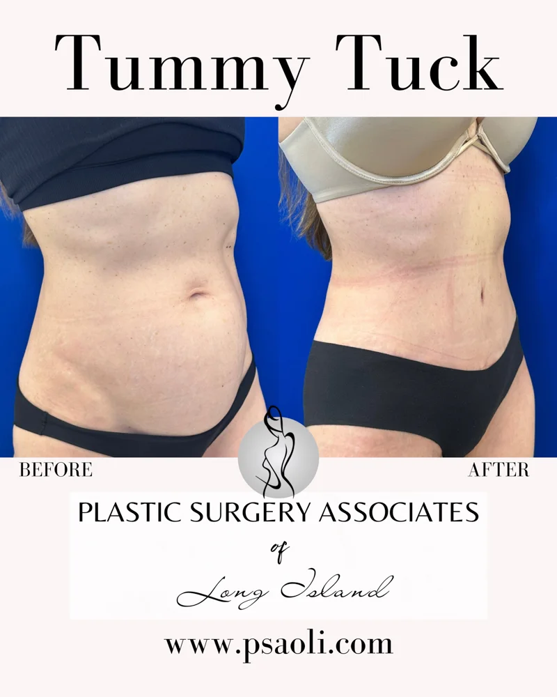 Tummy Tuck – 3