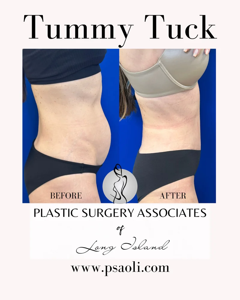 Tummy Tuck – 4