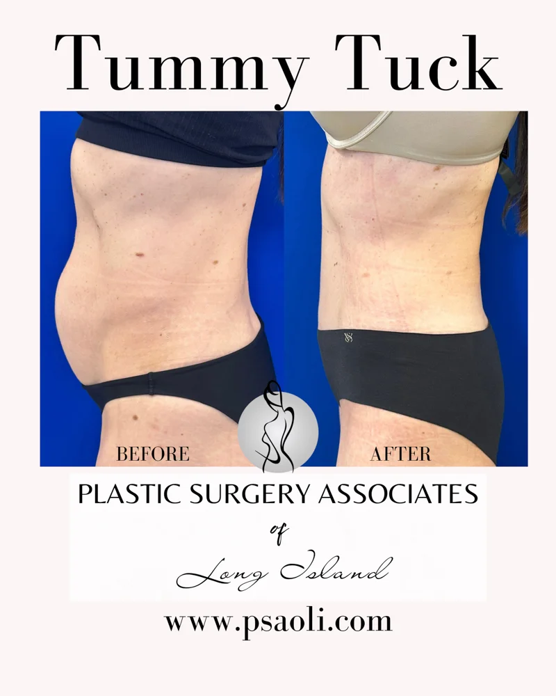 Tummy Tuck – 5