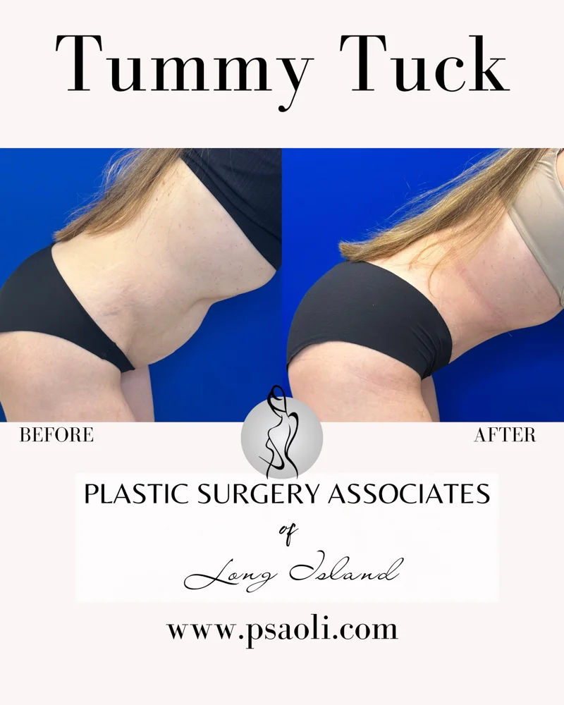 Tummy Tuck – 6