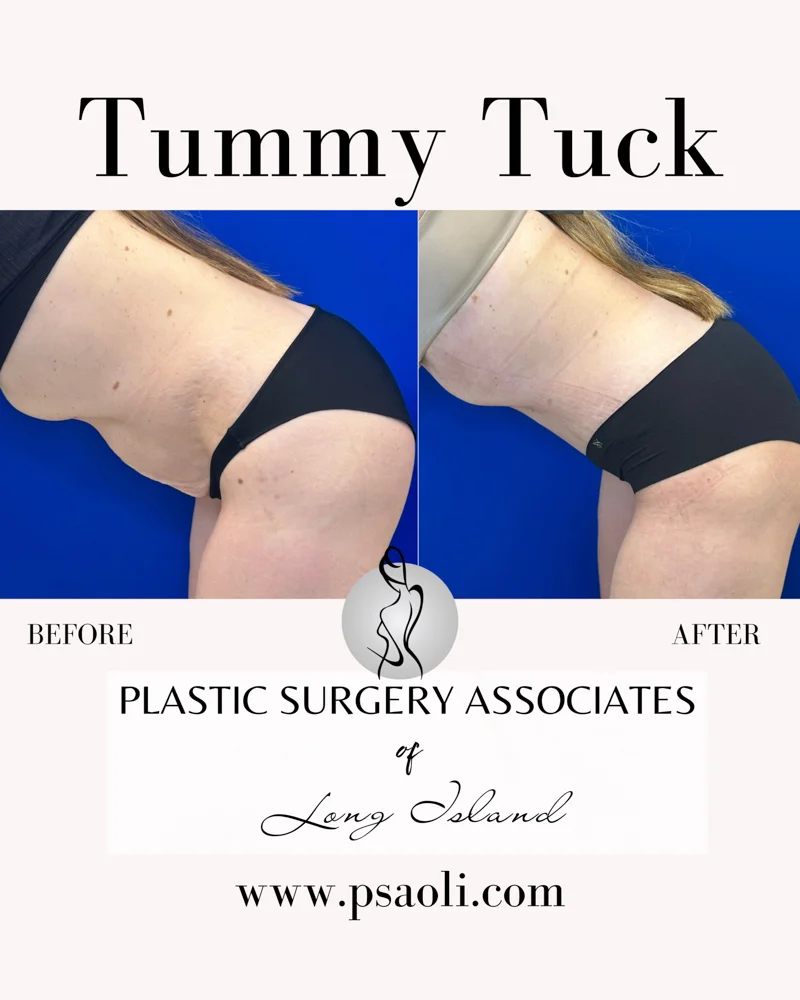 Tummy Tuck – 7