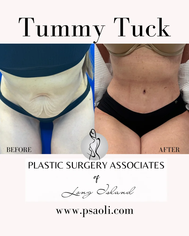 Tummy Tuck – 8