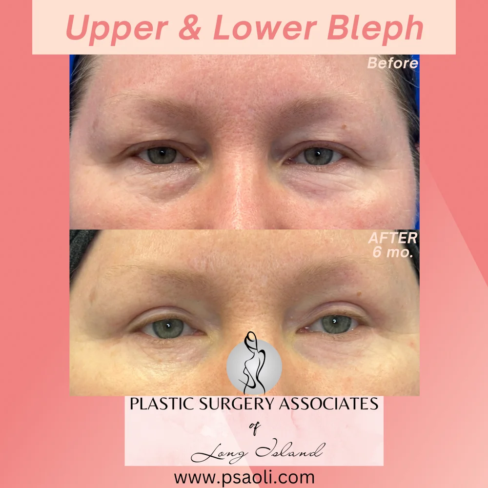 Upper & Lower Bleph – 1