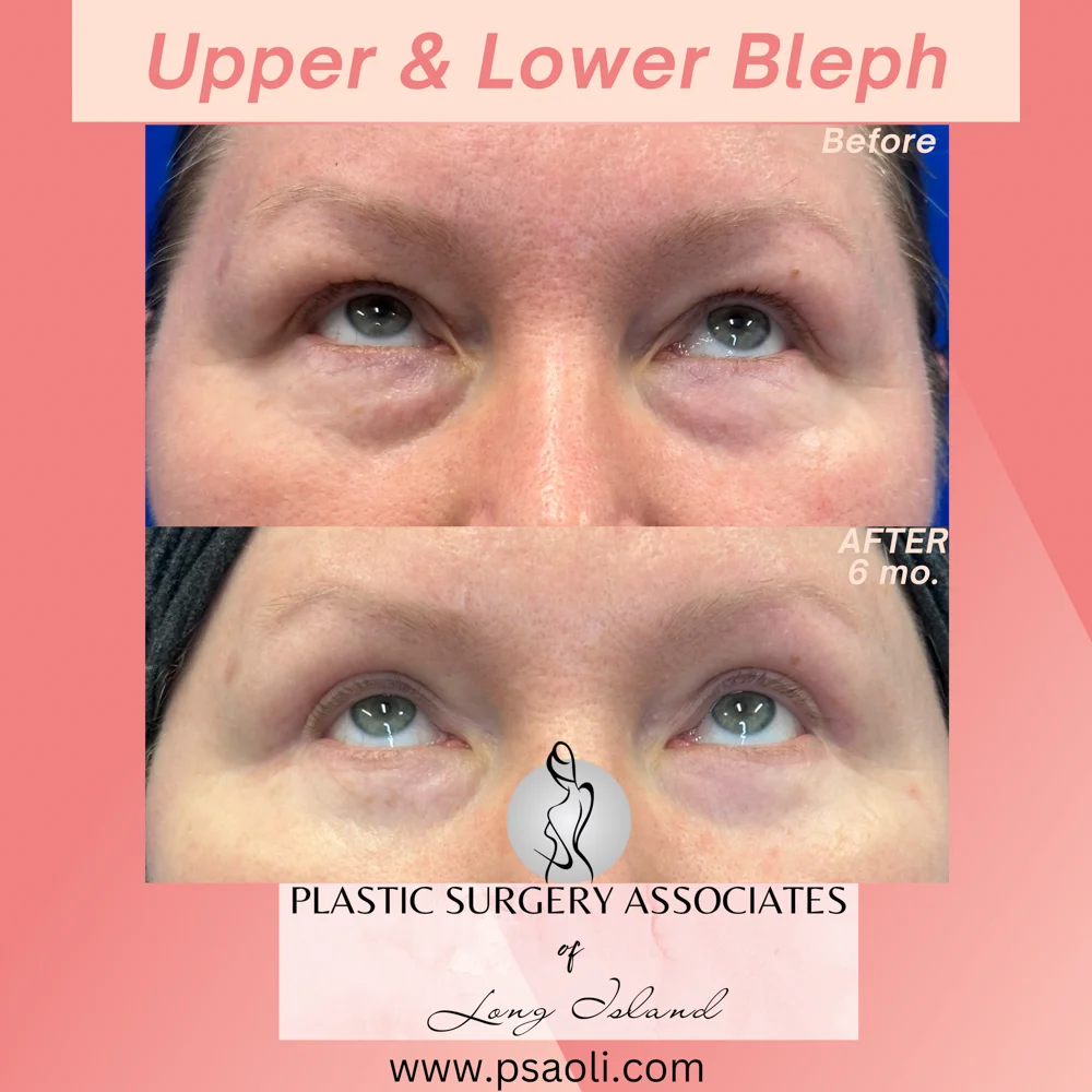 Upper & Lower Bleph – 2