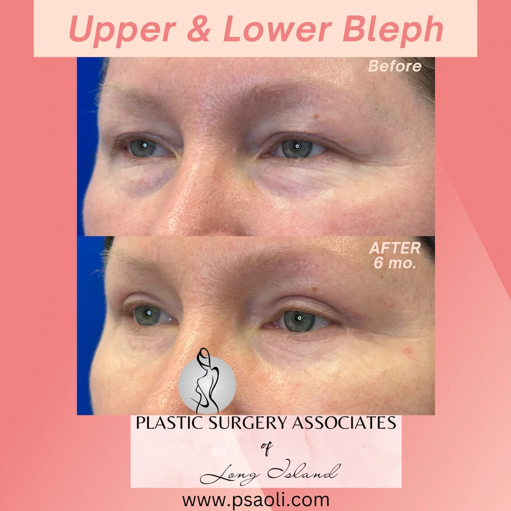 Upper & Lower Bleph – 3