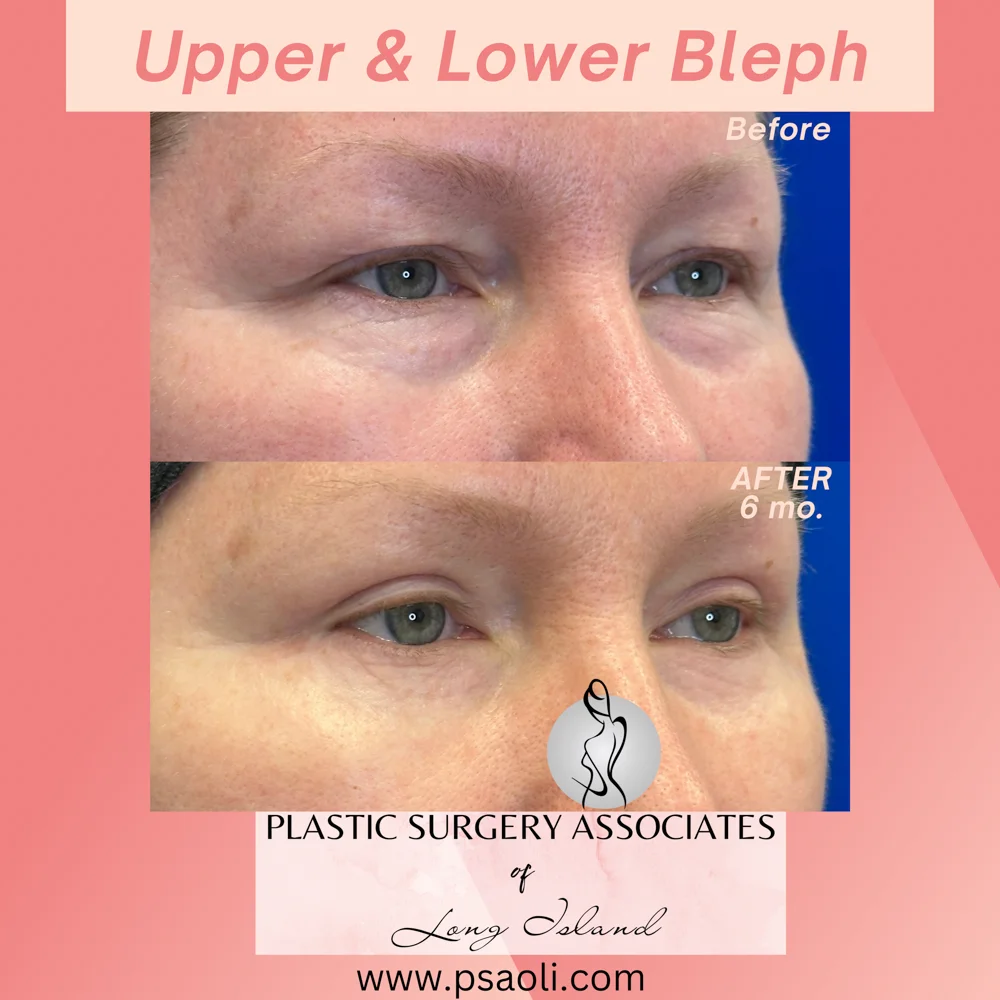 Upper & Lower Bleph – 4