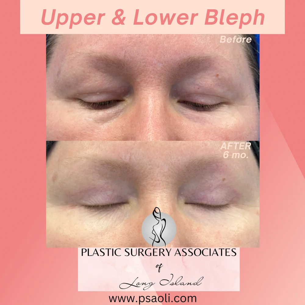 Upper & Lower Bleph – 5