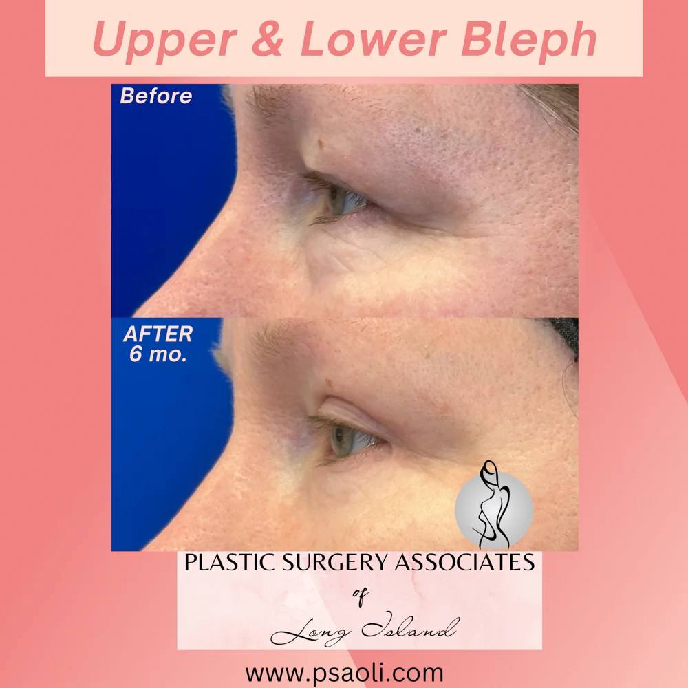 Upper & Lower Bleph – 6