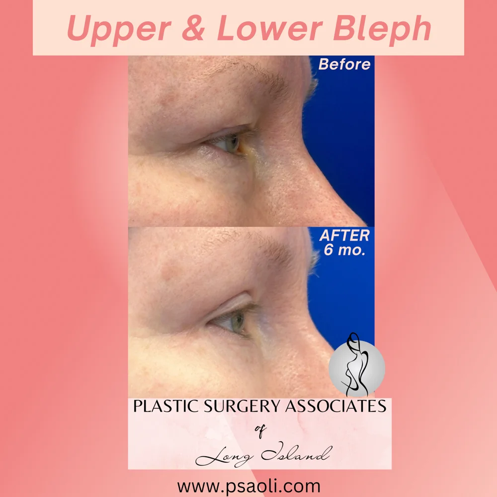 Upper & Lower Bleph – 7
