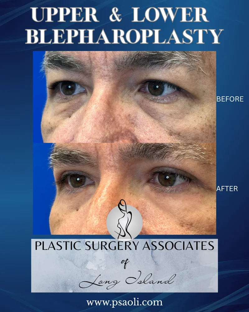 Upper & Lower Blepharoplasty – 1