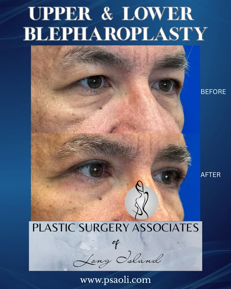 Upper & Lower Blepharoplasty – 2