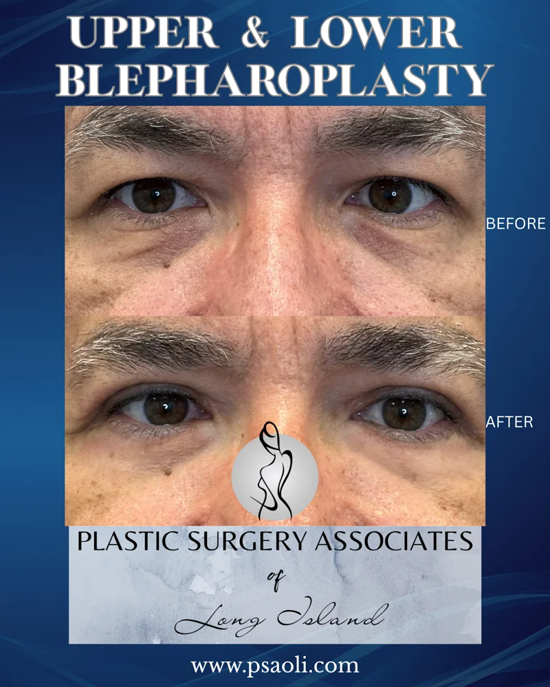 Upper & Lower Blepharoplasty – 3