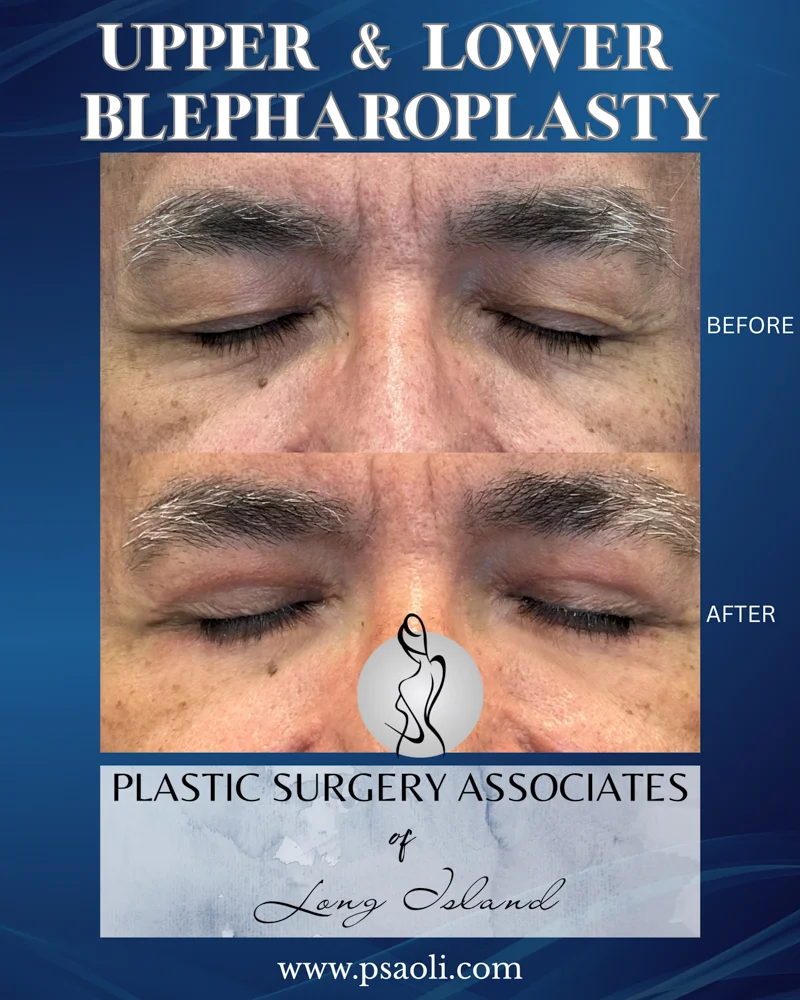 Upper & Lower Blepharoplasty – 4