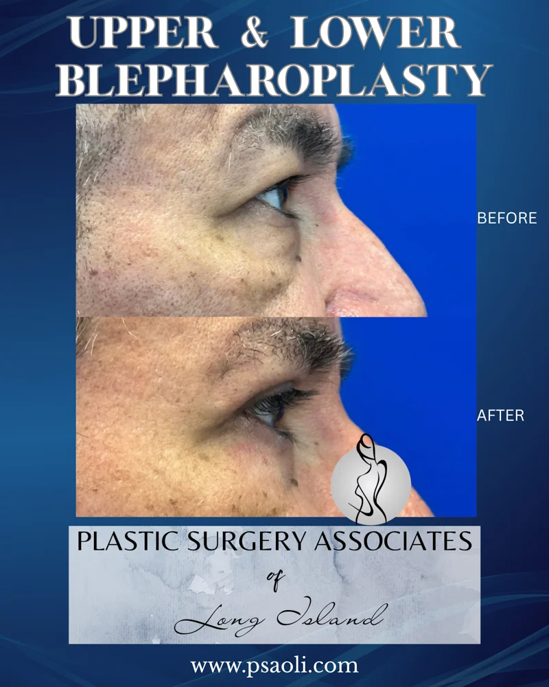 Upper & Lower Blepharoplasty – 5