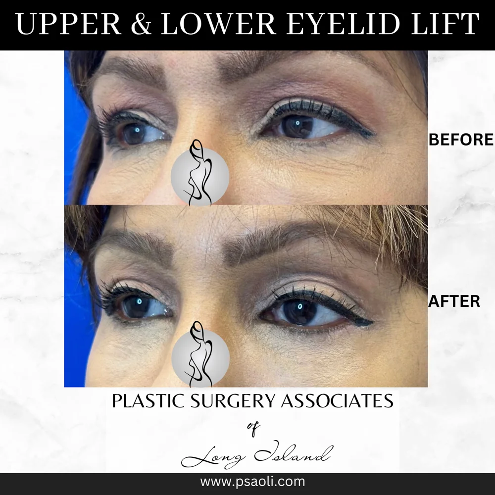 Upper & Lower eyelid lift – 2