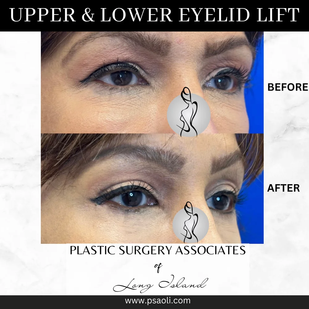 Upper & Lower eyelid lift – 3