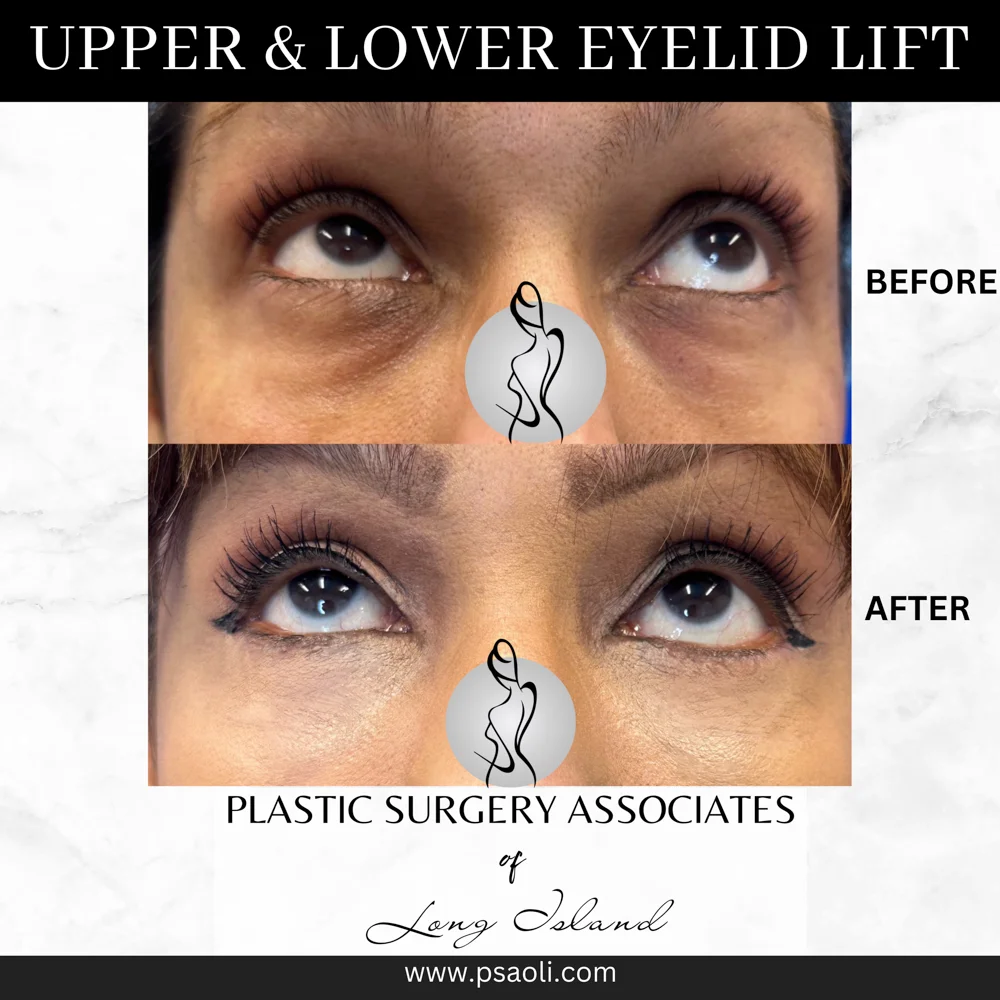 Upper & Lower eyelid lift – 4