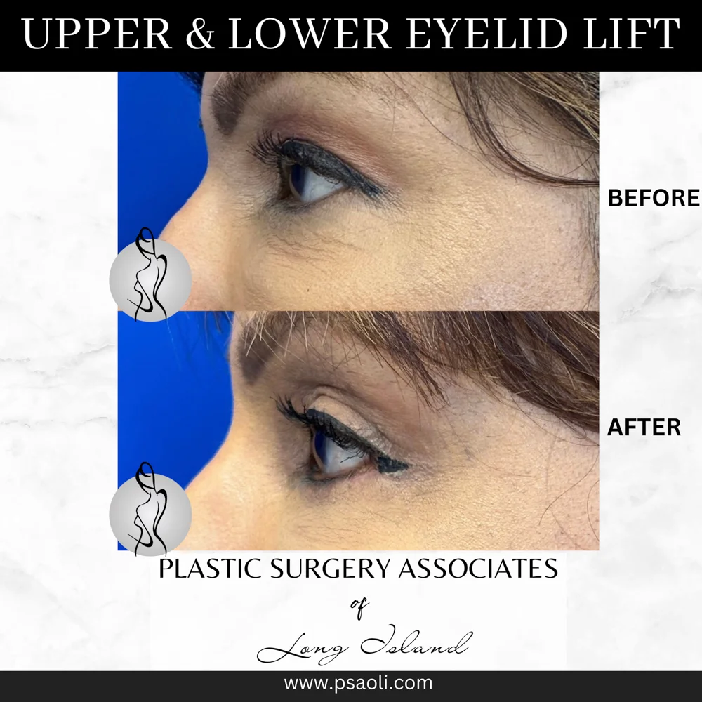 Upper & Lower eyelid lift – 5
