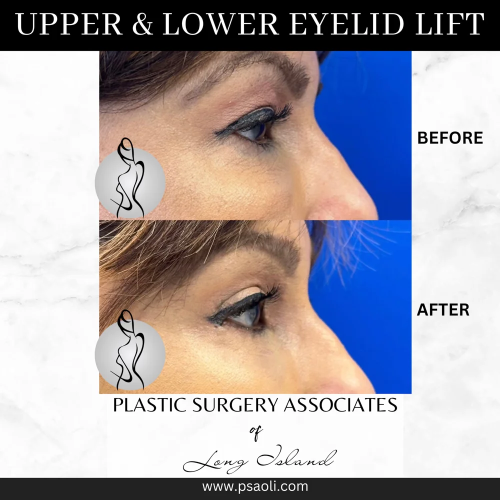 Upper & Lower eyelid lift – 6