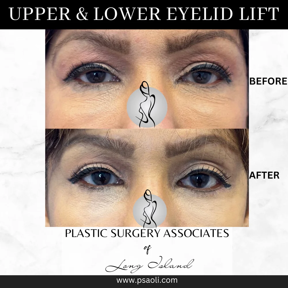 Upper & Lower eyelid lift – 7
